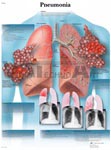 Pneumonia - Anatomical Chart